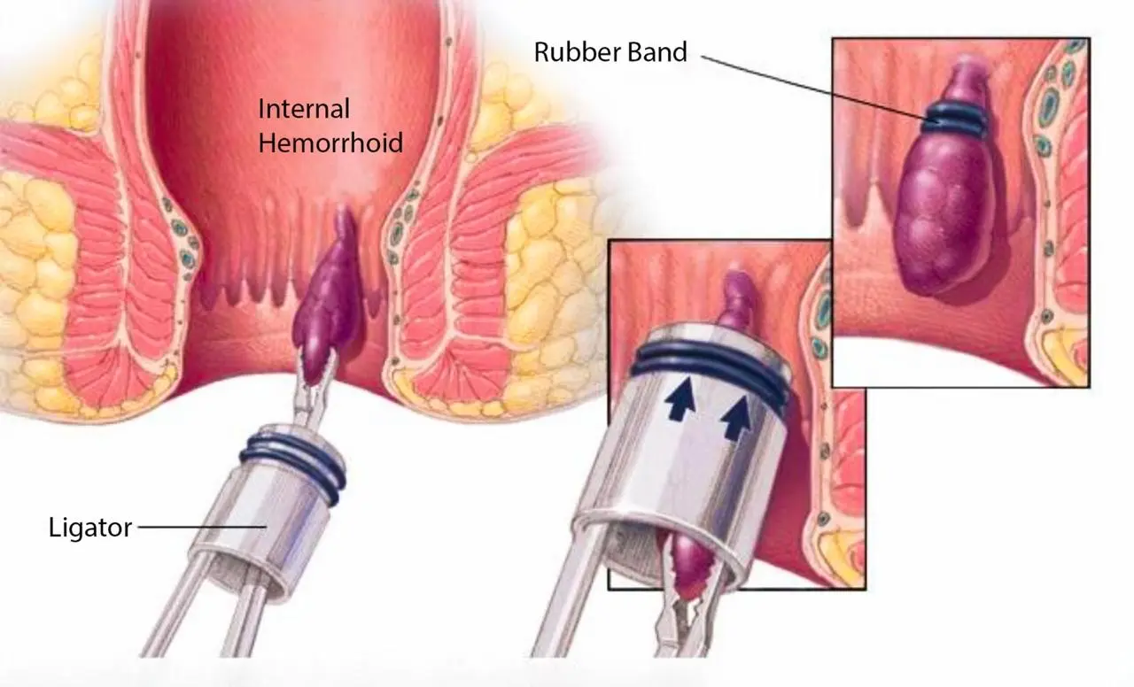 Rubber Band Ligation (RBL)